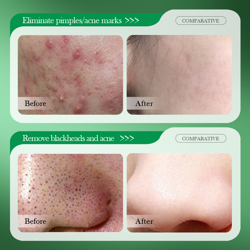 ครีมรักษาสิวกรดซาลิไซลิกซ่อมแซ - Salicylic Acid Blackhead Remover บทวิจารณ์และราคา